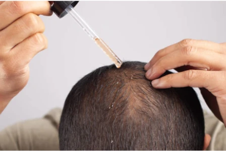 Lee más sobre el artículo Cómo aplicar el Minoxidil de Afrodita